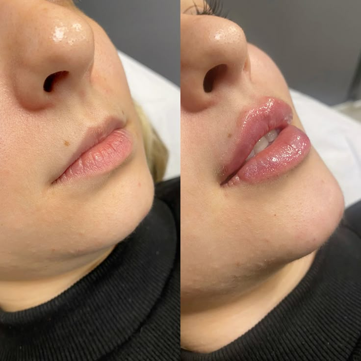 Lip Neutralization