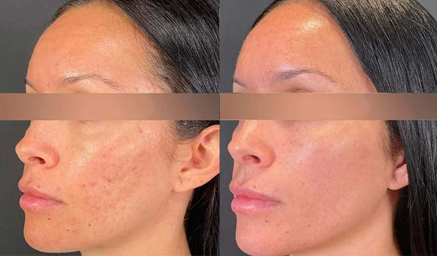 Microneedling (Acne Scar Removal)