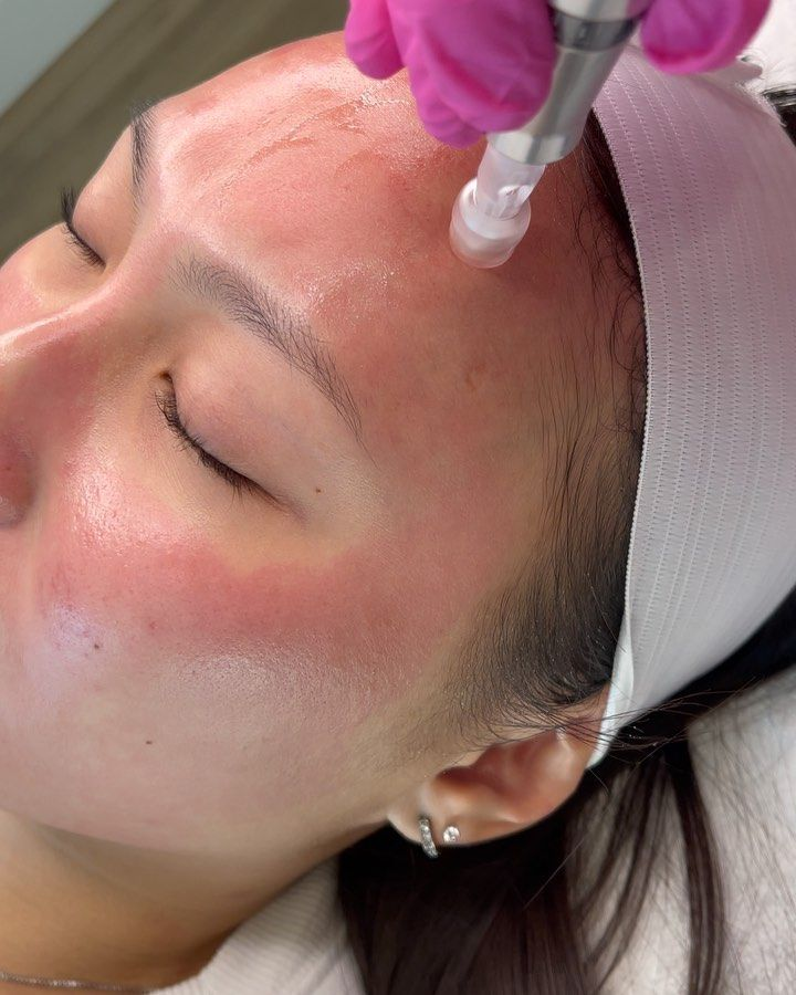 Microneedling 6-Session Package